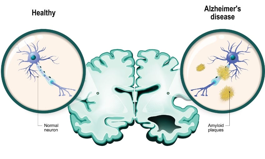 Alzheimer's Disease Causes
