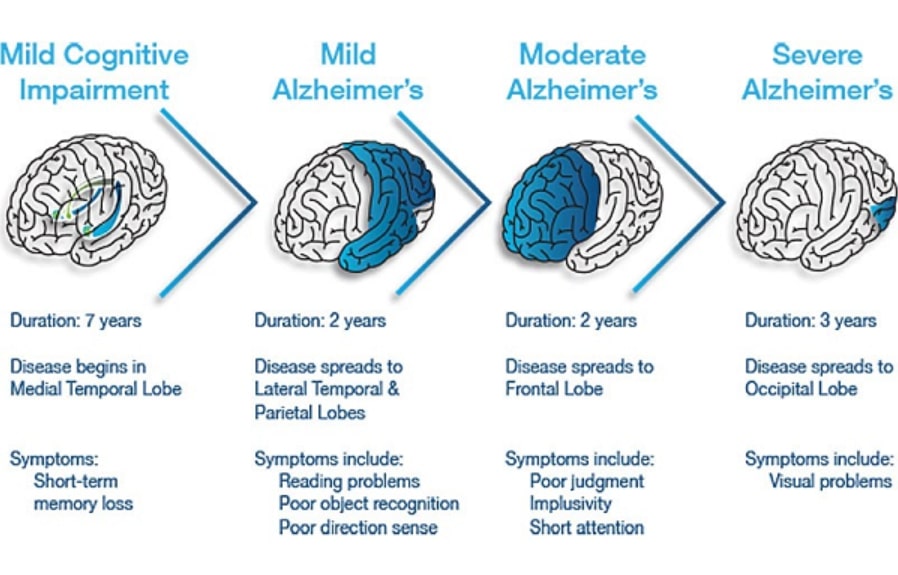 Alzheimer's Disease Stages