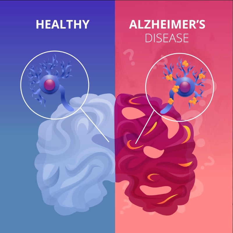 Understanding Alzheimers Disease Causes Stages Life Expectancy And Treatment